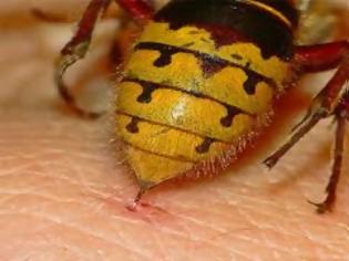 Φωτογραφία για Πρώτες βοήθειες για τσίμπημα μέλισσας, σφήκας ή σφίγγας ή σφήγκας. Πώς να αφαιρέσετε το κεντρί. Αντιμετώπιση αλλεργικής αντίδρασης