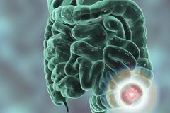 Καρκίνος εντέρου: Το διατροφικό μυστικό για την αποτελεσματική αντιμετώπισή του