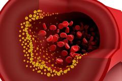 Αθηροσκλήρωση και συμπτώματα