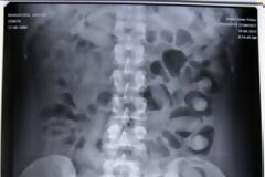 Nεαρές Βραζιλιάνες είχαν καταπιεί 185 συσκευασίες με κοκαΐνη