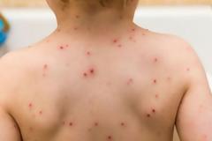 Ιλαρά: 88 νέα κρούσματα την τελευταία εβδομάδα