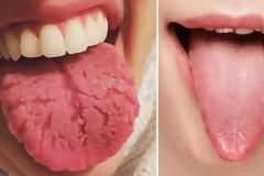 Πήγαινε τώρα σε έναν καθρέφτη και κοίτα τη γλώσσα σου. Αν είναι έτσι πρέπει να πας αμέσως σε γιατρό