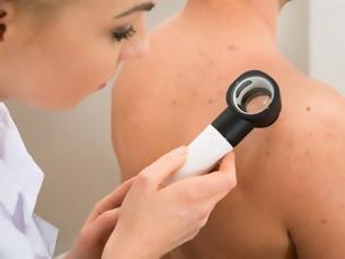 Φωτογραφία για Κάντε το τεστ για να δείτε αν κινδυνεύετε περισσότερο από τον καρκίνο του δέρματος;