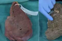 Η διαφορά ανάμεσα σε ένα υγιές συκώτι και ένα συκώτι αλκοολικού