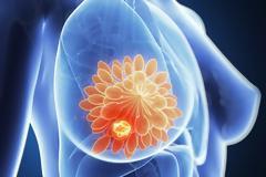 Καρκινικός δείκτης για τον καρκίνο του μαστού, το καρκινικό αντιγόνο 15-3 (CA 15-3)