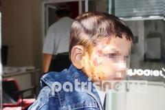 Σε 34 μήνες φυλάκιση ο άνδρας που έλουσε με καυτό καφέ δίχρονο αγοράκι στην Ηλεία