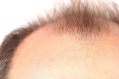 Αποτελέσματα και κατά της φαλάκρας φαίνεται να έχει ένα φάρμακο για την οστεοπόρωση