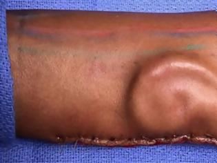 Φωτογραφία για Αμερικανοί γιατροί «φύτρωσαν» αυτί σε χέρι στρατιωτικού