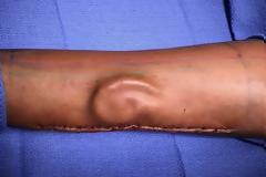 Χρειαζόταν καινούργιο αυτί – Οι γιατροί ανέπτυξαν ένα στο… χέρι της! [video]