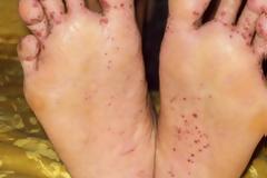 Μύκητες στο πέλμα: Συμπτώματα και ποιοι κινδυνεύουν περισσότερο