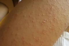 Δυσανεξία στη γλουτένη: Αν προσέξετε αυτά τα συμπτώματα, κάντε εξέταση!