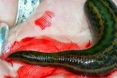 Έπαθαν αμόκ οι γιατροί με αυτό που αντίκρισαν – Κoριτσάκι υπέφερε από πονόλαιμο και δείτε τι βρήκαν στο λαιμό της