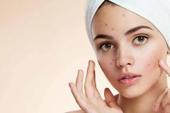 Αυξημένος ο κίνδυνος σοβαρής κατάθλιψης μετά την εμφάνιση ακμής στο πρόσωπο