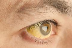 Καρκίνος στο πάγκρεας: 7 άγνωστα συμπτώματα του πιο θανατηφόρου καρκίνου