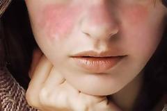 Συστηματικός Ερυθηματώδης Λύκος: εξουθενώνει τους ασθενείς