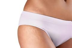 Μπορούν οι ραγάδες να αντιμετωπιστούν με κρέμες;