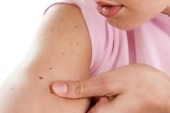 Μελάνωμα: Πόσες ελιές (αριθμός) στο χέρι σας δείχνουν αυξημένο κίνδυνο