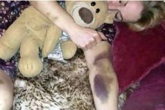 Όταν ξύπνησε, όλο της το κορμί ήταν γεμάτο μελανιές! Μετά από πέντε μέρες έμαθε την πικρή αλήθεια… [photo]