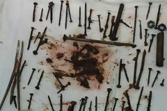 Γυναίκα κατάπιε καρφιά και βίδες - Δεν διανοείστε για ποιον λόγο! [photos]