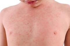 Ερώτηση ΝΔ: Καλπάζει η ιλαρά! Τι γίνεται στο Νοσοκομείο του Κιλκίς;