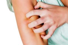 Τσιμπήματα κουνουπιών: Πώς μειώνεται γρήγορα το πρήξιμο και η φαγούρα