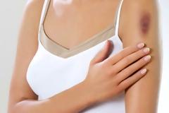 Γιατί κάνουμε μελανιά, όταν χτυπάμε;