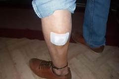 Στο κέντρο υγείας ηλικιωμένος από δάγκωμα σκύλου στη Βόνιτσα (δείτε φωτο)