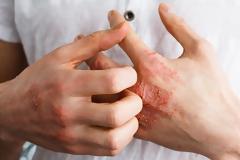 Αυξημένο καρδιακό κίνδυνο αντιμετωπίζουν οι ενήλικες με σοβαρό έκζεμα