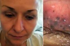 Σοκ: Για 25 χρόνια δεν έβγαζε τη μάσκαρα από τα μάτια της - Δείτε τι έπαθε! [Σκληρές Εικόνες]