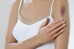 Γιατί μελανιάζω τόσο εύκολα;