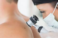 Καρκίνος του δέρματος: Καλύτερη η διάγνωση με την τεχνητή νοημοσύνη λένε οι δερματολόγοι