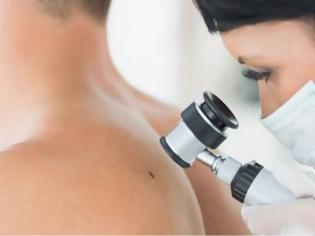 Φωτογραφία για Καρκίνος του δέρματος: Καλύτερη η διάγνωση με την τεχνητή νοημοσύνη λένε οι δερματολόγοι
