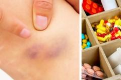 Γιατί μελανιάζω με το παραμικρό; 9 πιθανές αιτίες