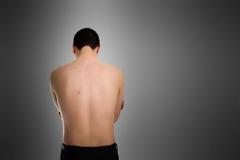 Βγάζετε σπυράκια στην πλάτη; Τι να κάνετε για να το αντιμετωπίσετε;