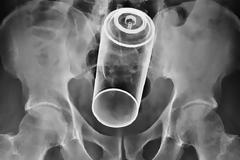 ΔΕΙΤΕ 20 παράξενα αντικείμενα που έχουν βρεθεί μέσα σε… πισινούς!