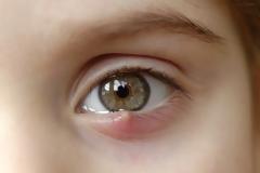 Κριθαράκι στο μάτι: Αίτια, θεραπεία και πρόληψη