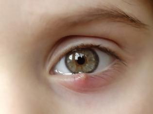 Φωτογραφία για Κριθαράκι στο μάτι: Αίτια, θεραπεία και πρόληψη