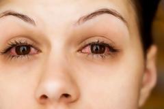 Αλλεργία στα μάτια: Αντιμετώπιση για φαγούρα, κοκκίνισμα και δάκρυα [video]