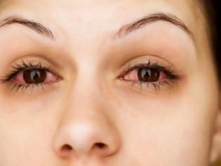 Φωτογραφία για Αλλεργία στα μάτια: Αντιμετώπιση για φαγούρα, κοκκίνισμα και δάκρυα [video]