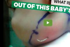 Γονείς είδαν μια κοκκινίλα στο λαιμό του μωρού τους! Οταν το πήγαν στο γιατρό, έπαθαν σοκ