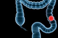 Ορθοκολικός καρκίνος: Τι είναι και με ποια συμπτώματα εκδηλώνεται;