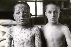 Φωτό-σοκ: Και τα δύο παιδιά έχουν ευλογιά, αλλά μόνο το ένα έχει εμβολιαστεί – Είναι αληθινή η φωτό που σόκαρε το διαδίκτυο;