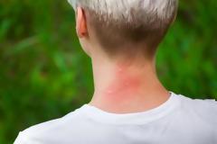 Πώς να απαλλαγείτε από τη φαγούρα αν σας τσιμπήσει κουνούπι