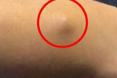 Εδώ και χρόνια είχε αυτό το σημάδι στο χέρι του. Όταν έμαθε τι ήταν, έπαθε το ΣΟΚ της ζωής του… [photos]