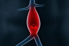 Ανεύρισμα αορτής: Δείτε ποιοι κινδυνεύουν περισσότερο