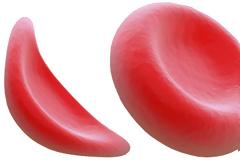 Παγκόσμια Ημέρα Δρεπανοκυτταρικής Νόσου, 19 Ιουνίου