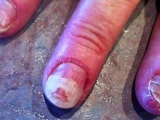 Φωτογραφία για ΣΟΚΑΡΙΣΤΙΚΟ: Τα νύχια αυτής της γυναίκας καταστράφηκαν με κάτι που κάνουν όλες οι γυναίκες [photo]