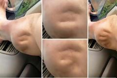 Δεν έχουμε ξαναδεί κάτι τέτοιο: Η εξωγήινη κράμπα άντρα που έγινε viral – Δείτε πώς γίνεται το πόδι του και ανατριχιάστε... [video]