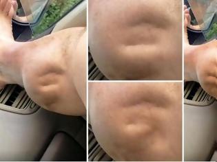 Φωτογραφία για Δεν έχουμε ξαναδεί κάτι τέτοιο: Η εξωγήινη κράμπα άντρα που έγινε viral – Δείτε πώς γίνεται το πόδι του και ανατριχιάστε... [video]