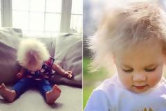 Γνωρίστε το μωρό που γεννήθηκε με το «σύνδρομο αχτένιστου μαλλιού»!